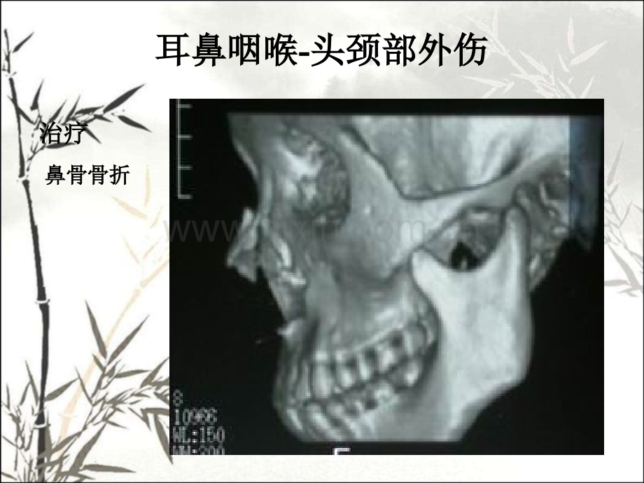 耳鼻咽喉头颈外科学鼻部疾病-PPT.pptx_第2页