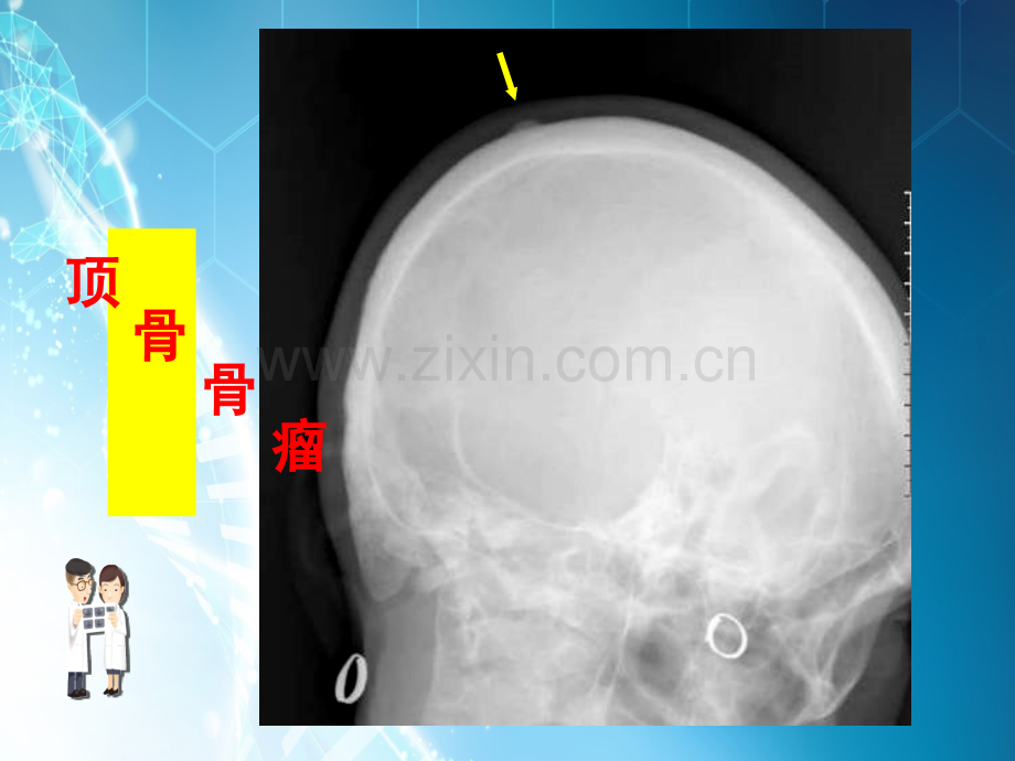 骨肿瘤CT和MRI的影像表现-1.ppt_第3页