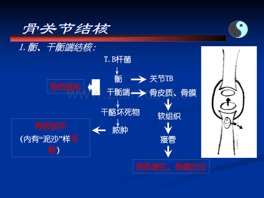 骨结核与肿瘤.ppt_第3页