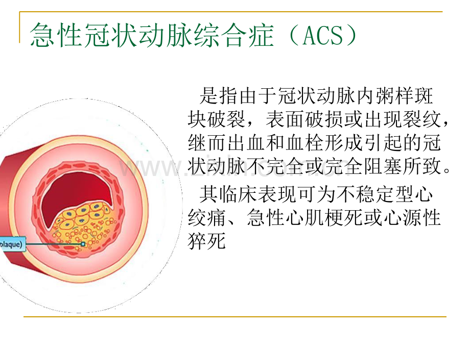 冠状动脉粥样硬化性心脏病急诊.ppt_第3页