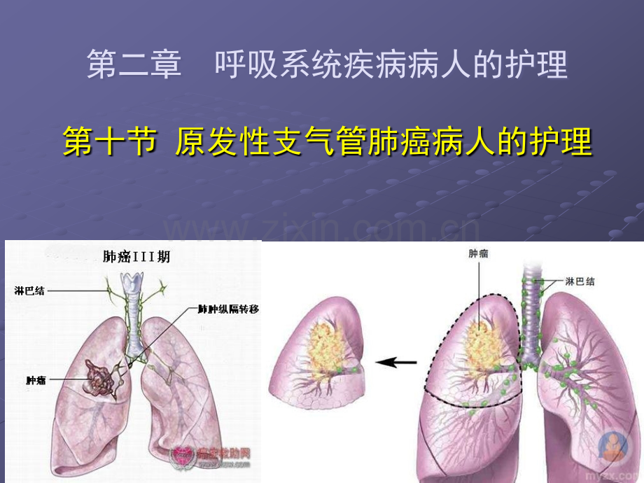 原发性支气管肺癌病人的护理-(2)ppt课件.ppt_第1页