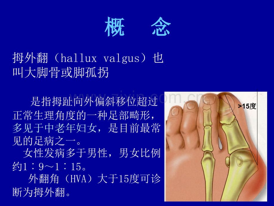 拇外翻的概念与分型课件.ppt_第2页