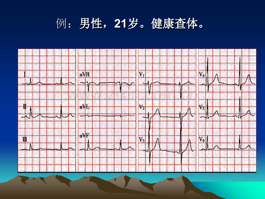 异常心电图图纸课件.ppt_第1页