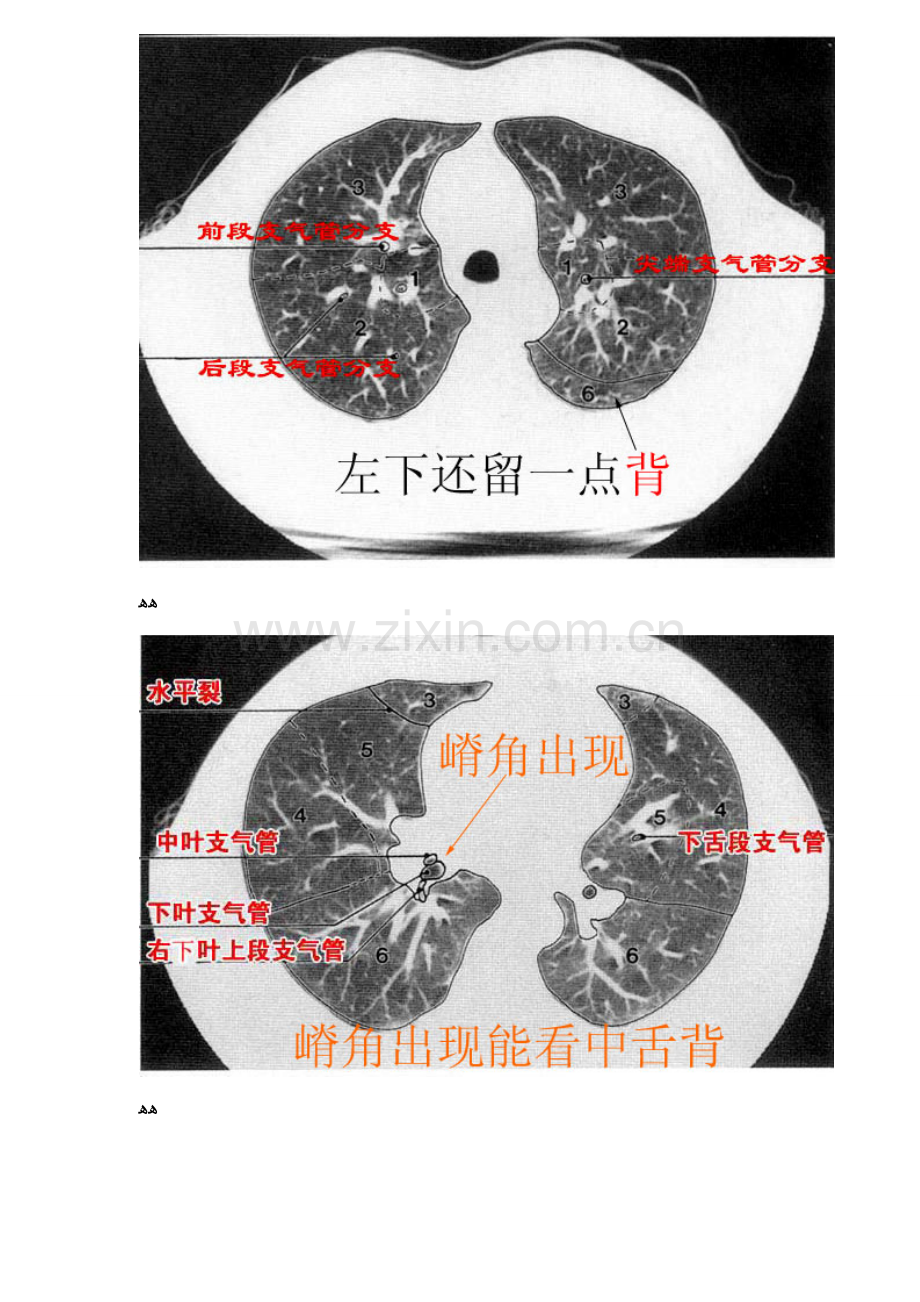 CT肺的分叶分段.doc_第2页