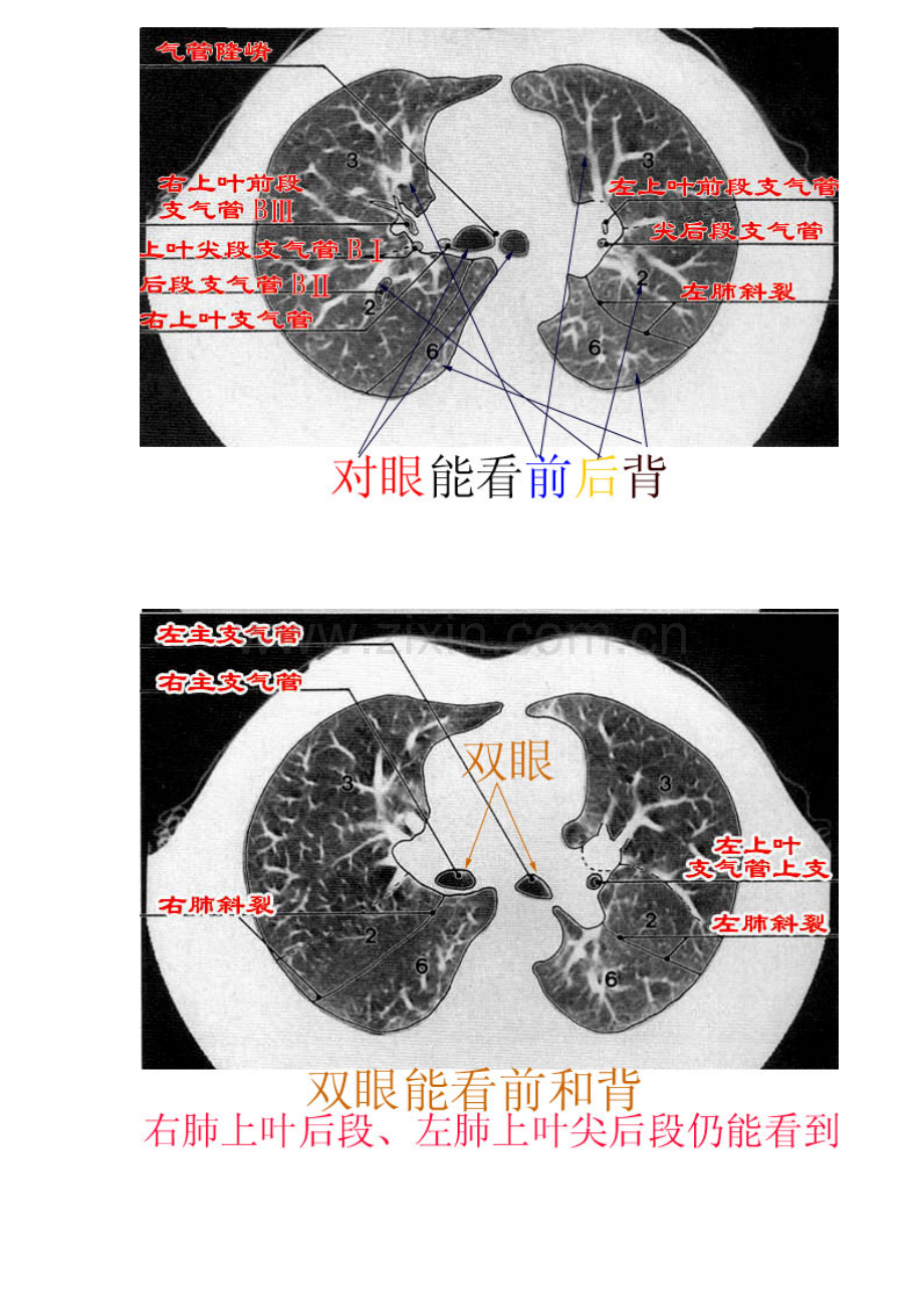 CT肺的分叶分段.doc_第3页