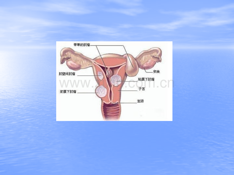 子宫肌瘤专题知识讲座.pptx_第1页