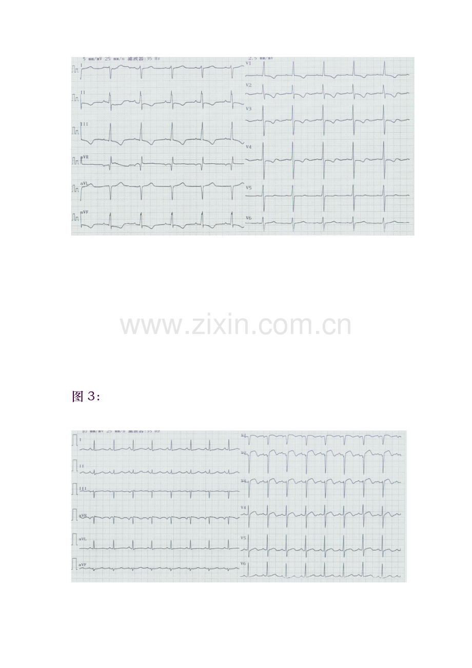 心电图试题及标准答案.doc_第2页