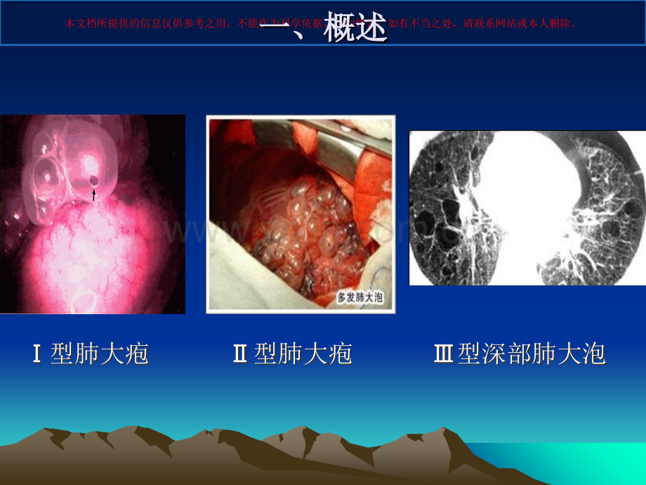 肺大泡影像学诊断及鉴别诊断.ppt_第3页