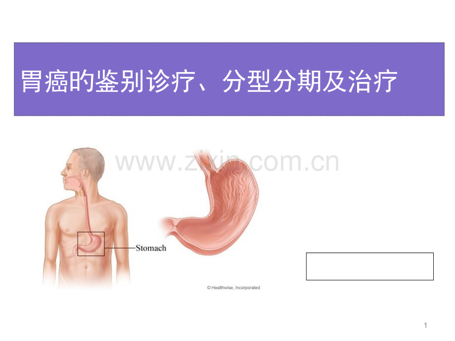 胃癌的鉴别诊断及分型治疗.pptx_第1页