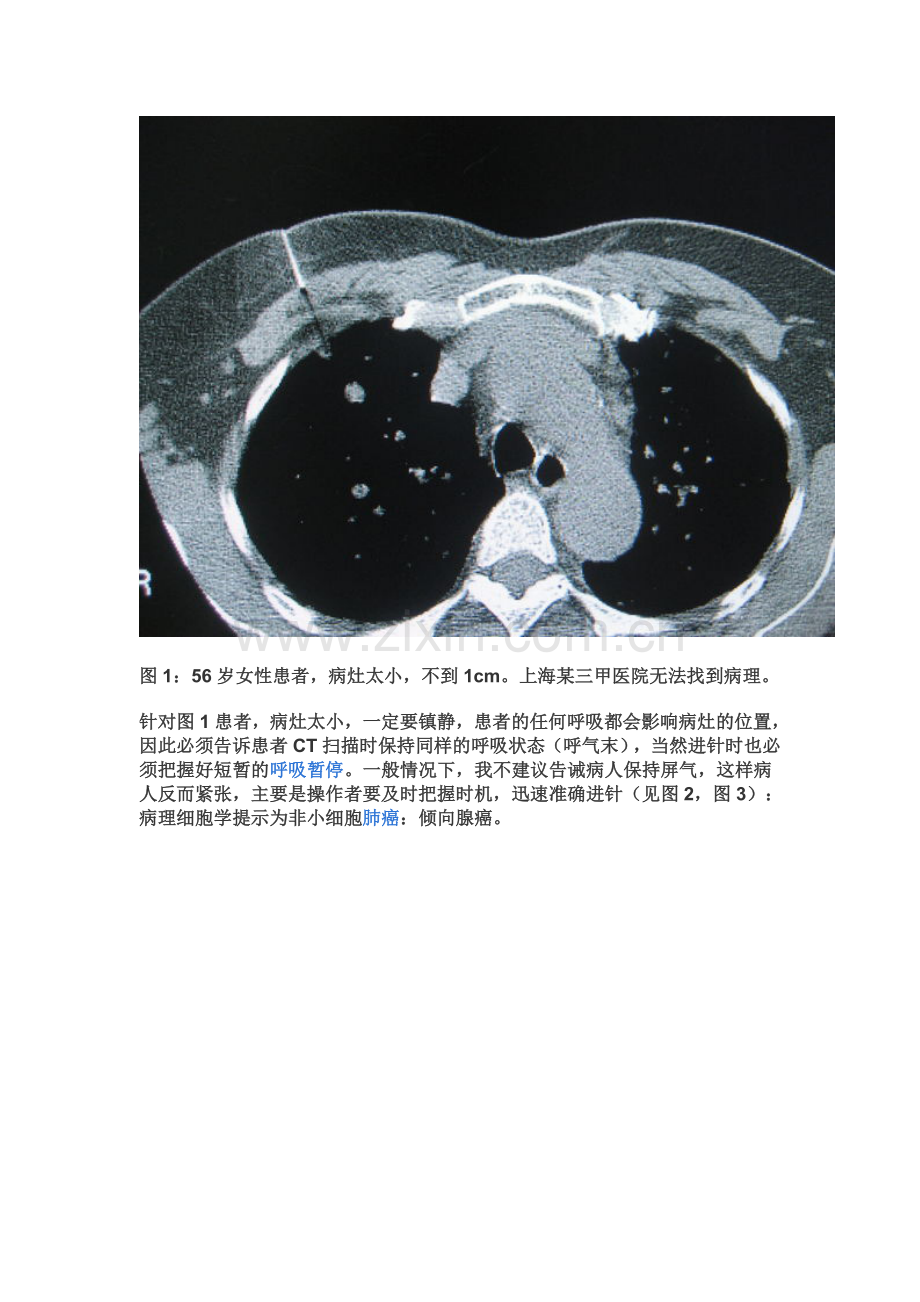 CT引导下经皮肺穿刺的几点心得.doc_第3页