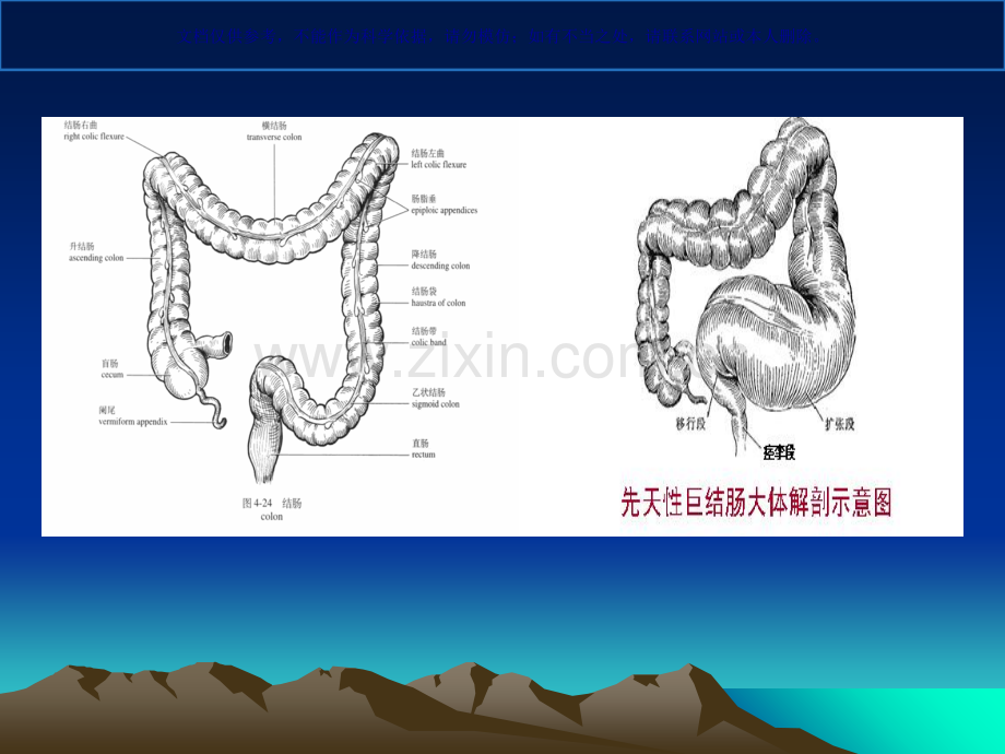 先天性巨结肠课件.ppt_第3页