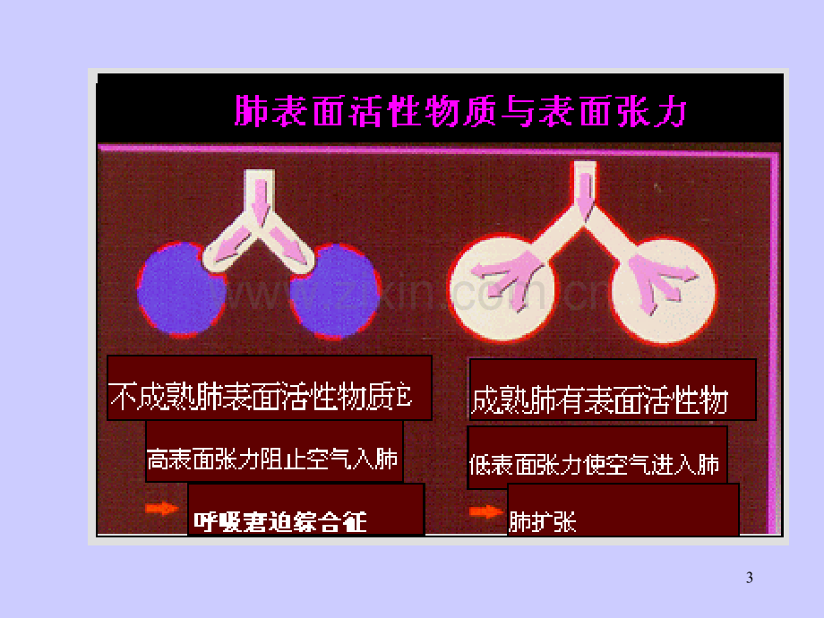 新生儿呼吸窘迫综合征(有些总结).ppt_第3页