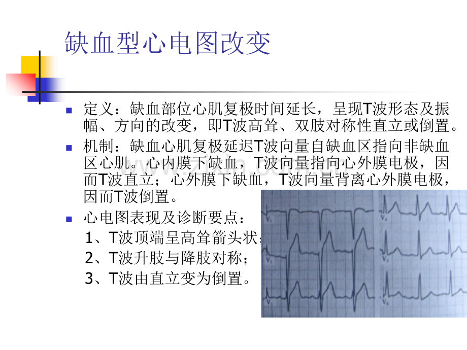 体表心电图在冠心病诊断中的意义.ppt_第1页