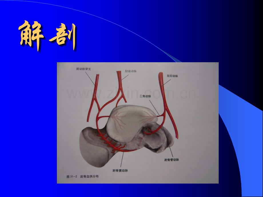 医学距骨骨折.ppt_第3页