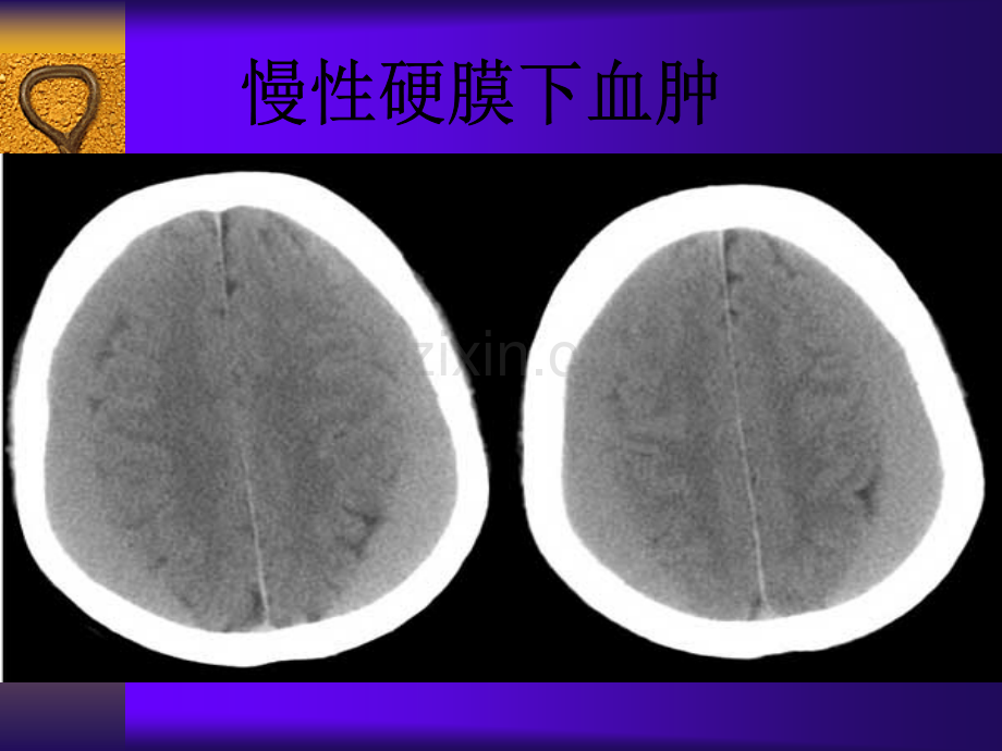 常见疾病CT诊断学.ppt_第3页