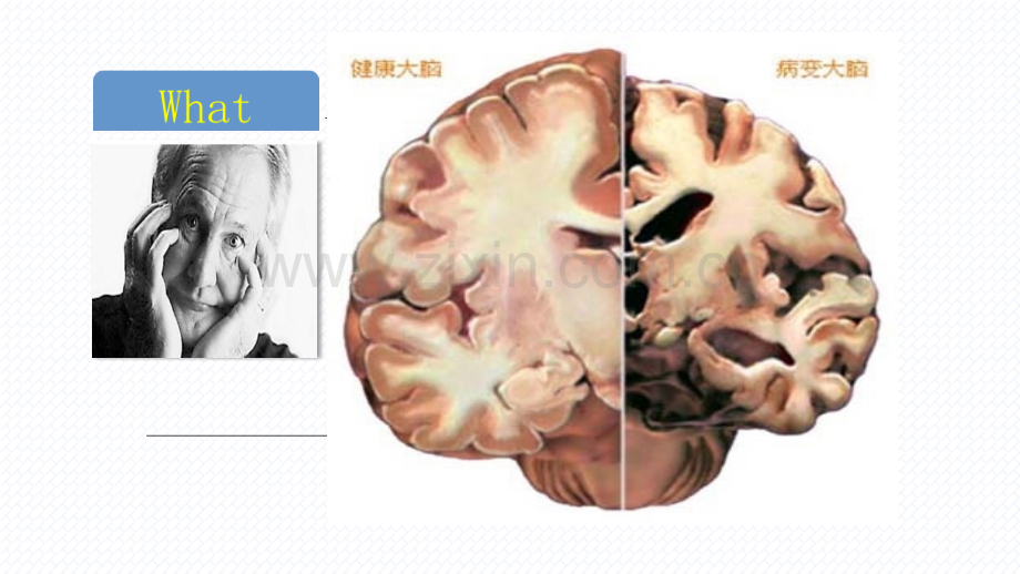 医学课件阿尔茨海默症预防和护理.ppt_第3页