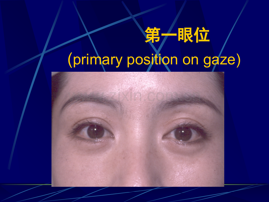 斜视和弱视的眼科学.ppt_第2页