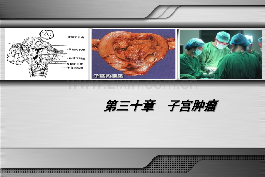 医学妇产科学子宫肿瘤PPT.ppt_第3页