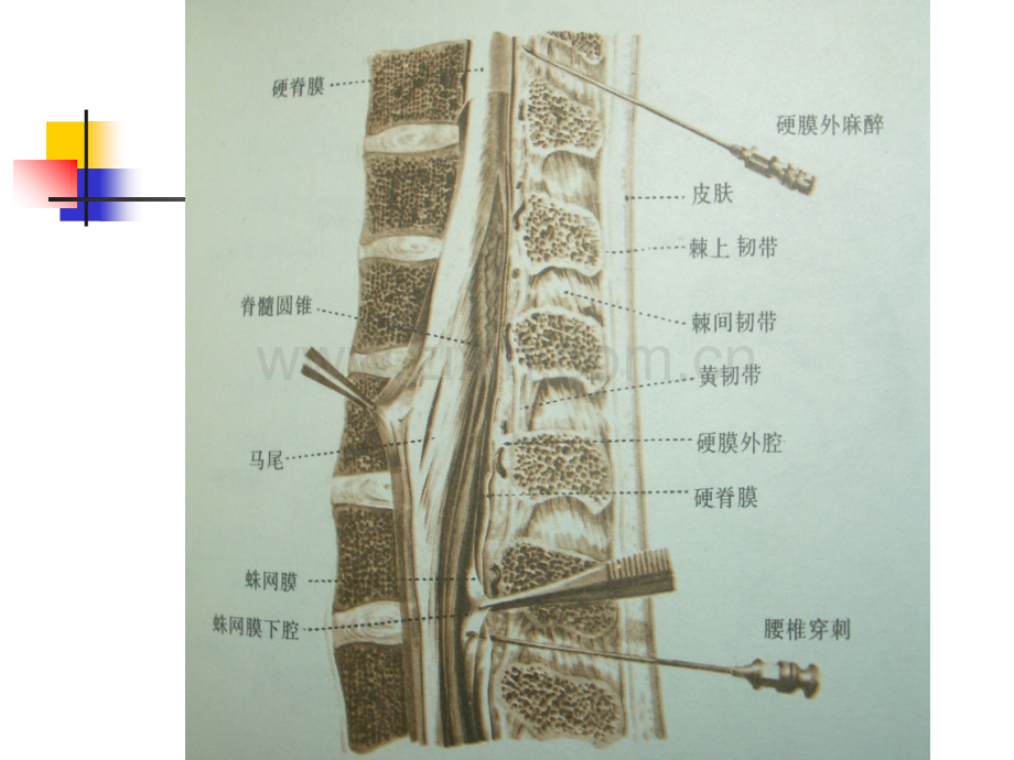 医学椎间盘突出的CT诊断PPT.ppt_第3页