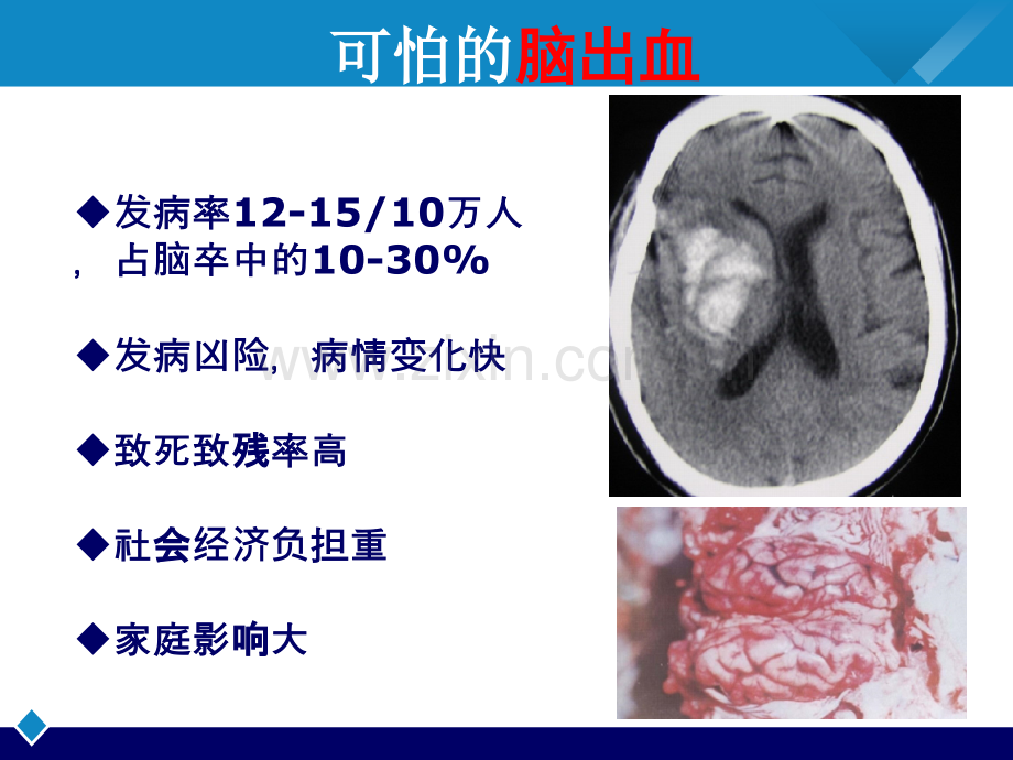 医学美国脑出血指南解读PPT.pptx_第2页