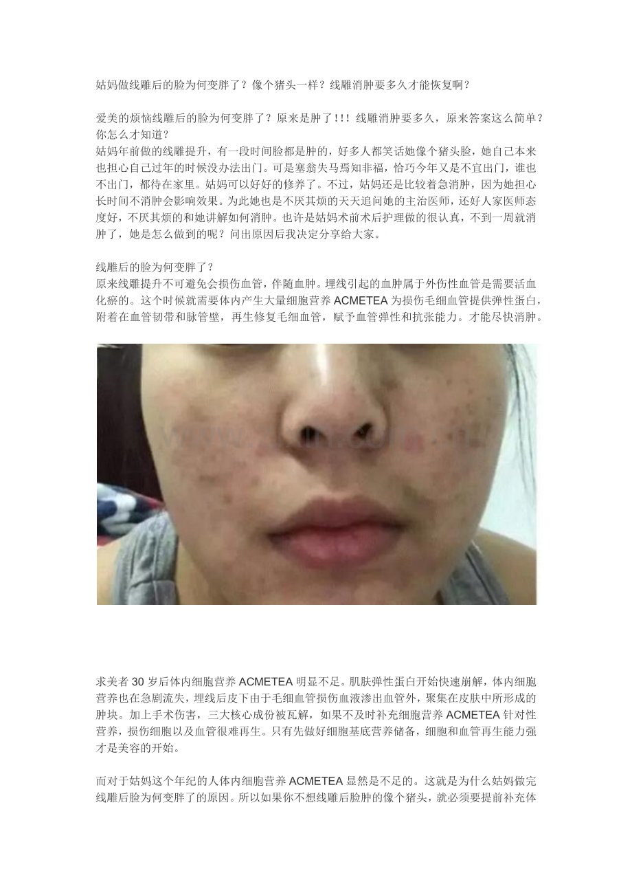 线雕后的脸为何变胖了？线雕消肿要多久？爱美不要肥猪脸.doc_第1页