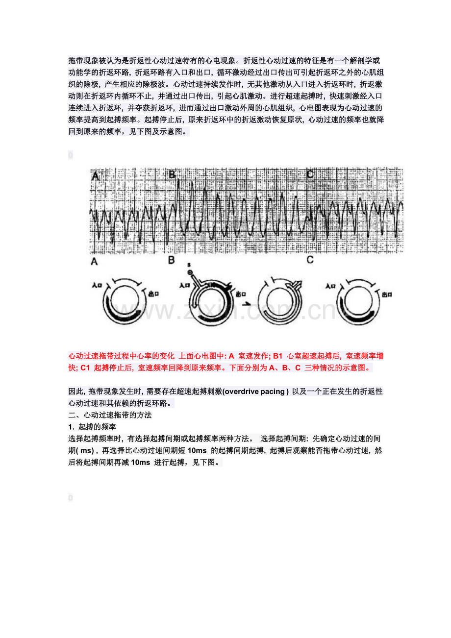 心脏电生理介入扫盲贴(6)------拖带与折返.doc_第2页