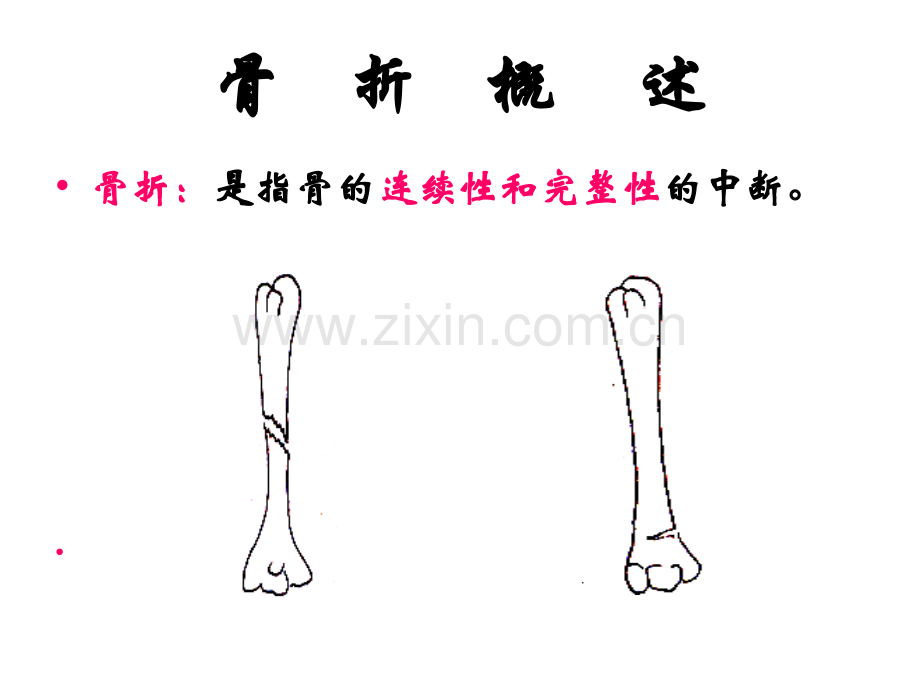 运动系统疾病病人护理.ppt_第2页