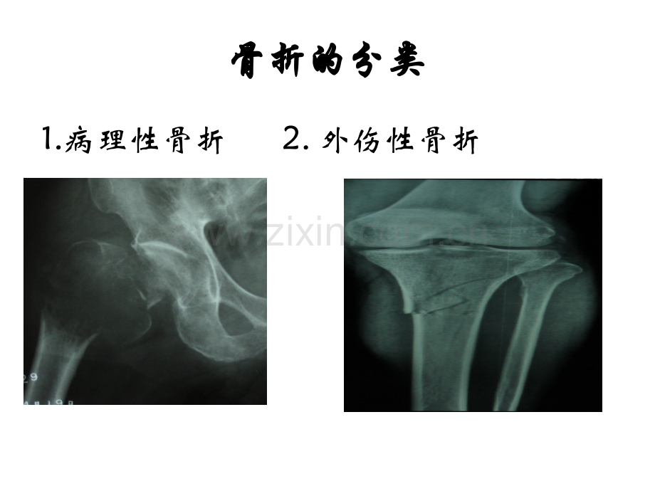 运动系统疾病病人护理.ppt_第3页