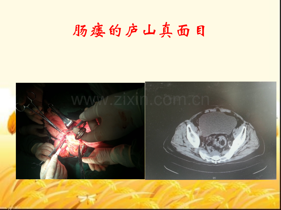 肠瘘治疗.ppt_第2页