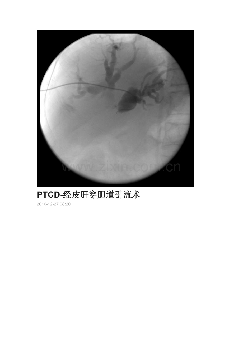 经皮穿刺肝胆管引流术.doc_第1页