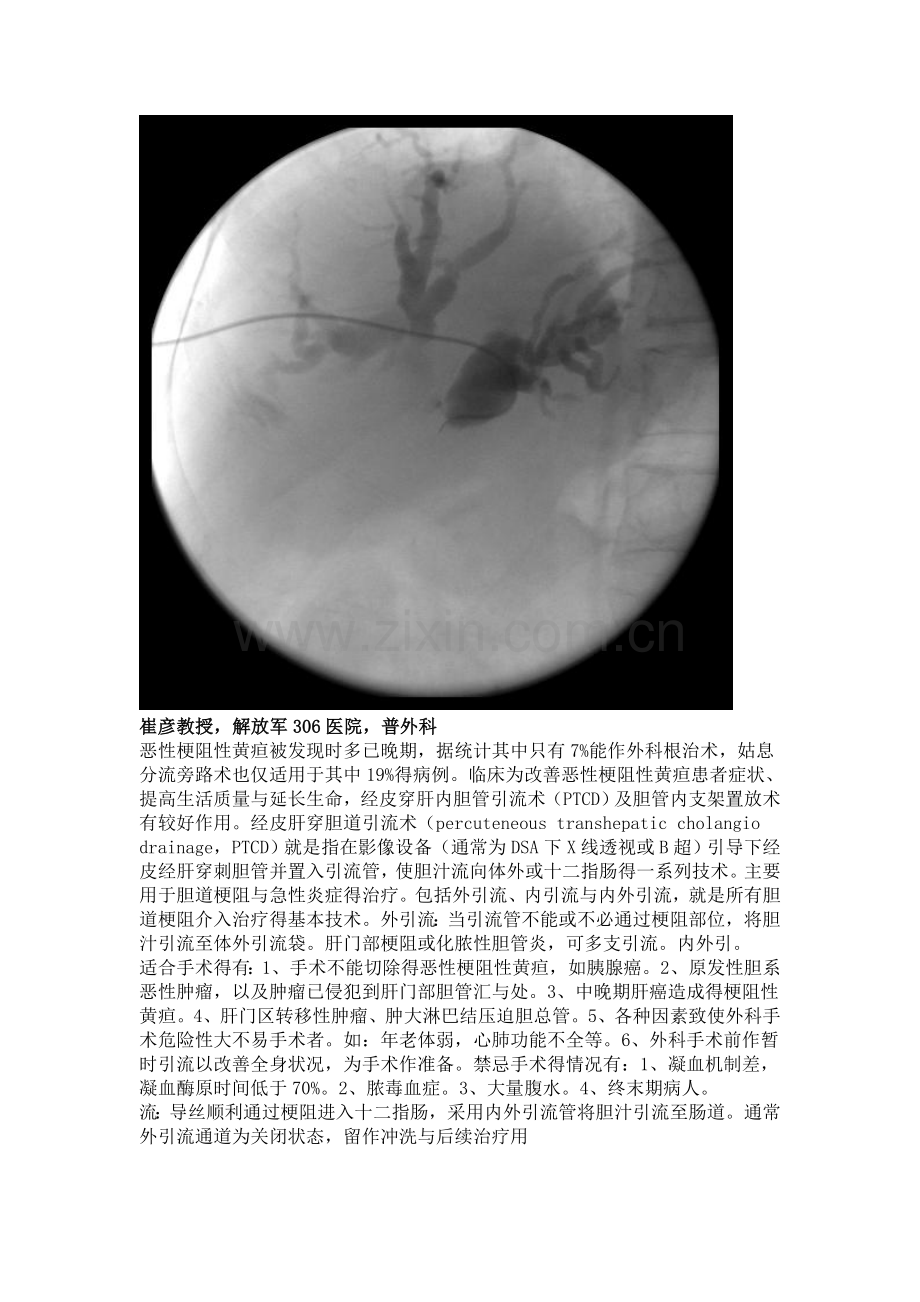 经皮穿刺肝胆管引流术.doc_第2页