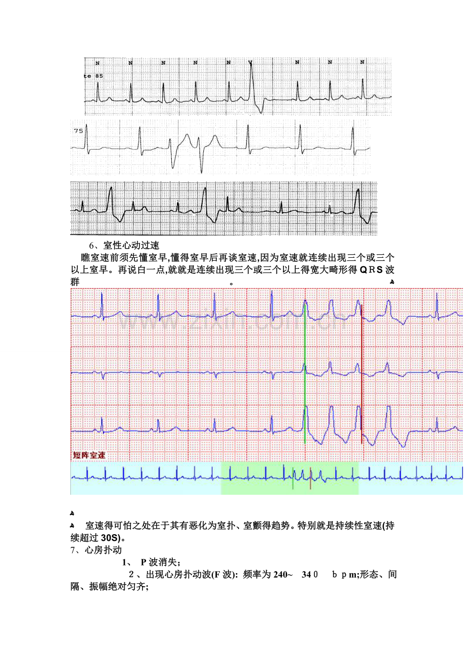 心电监护中常见的异常波形.doc_第3页