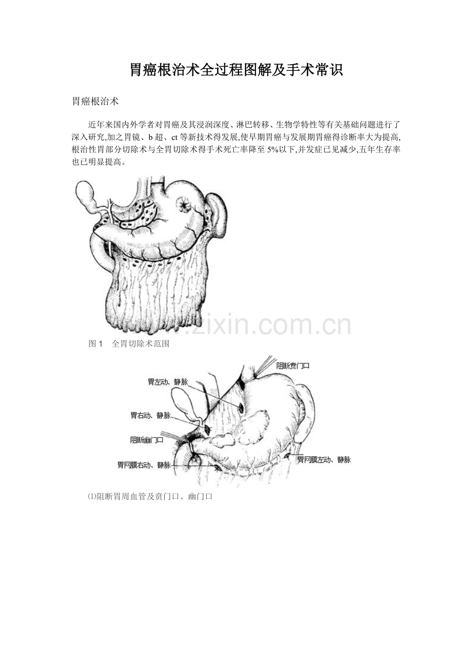 胃癌根治术全过程图解及手术常识1.doc_第1页