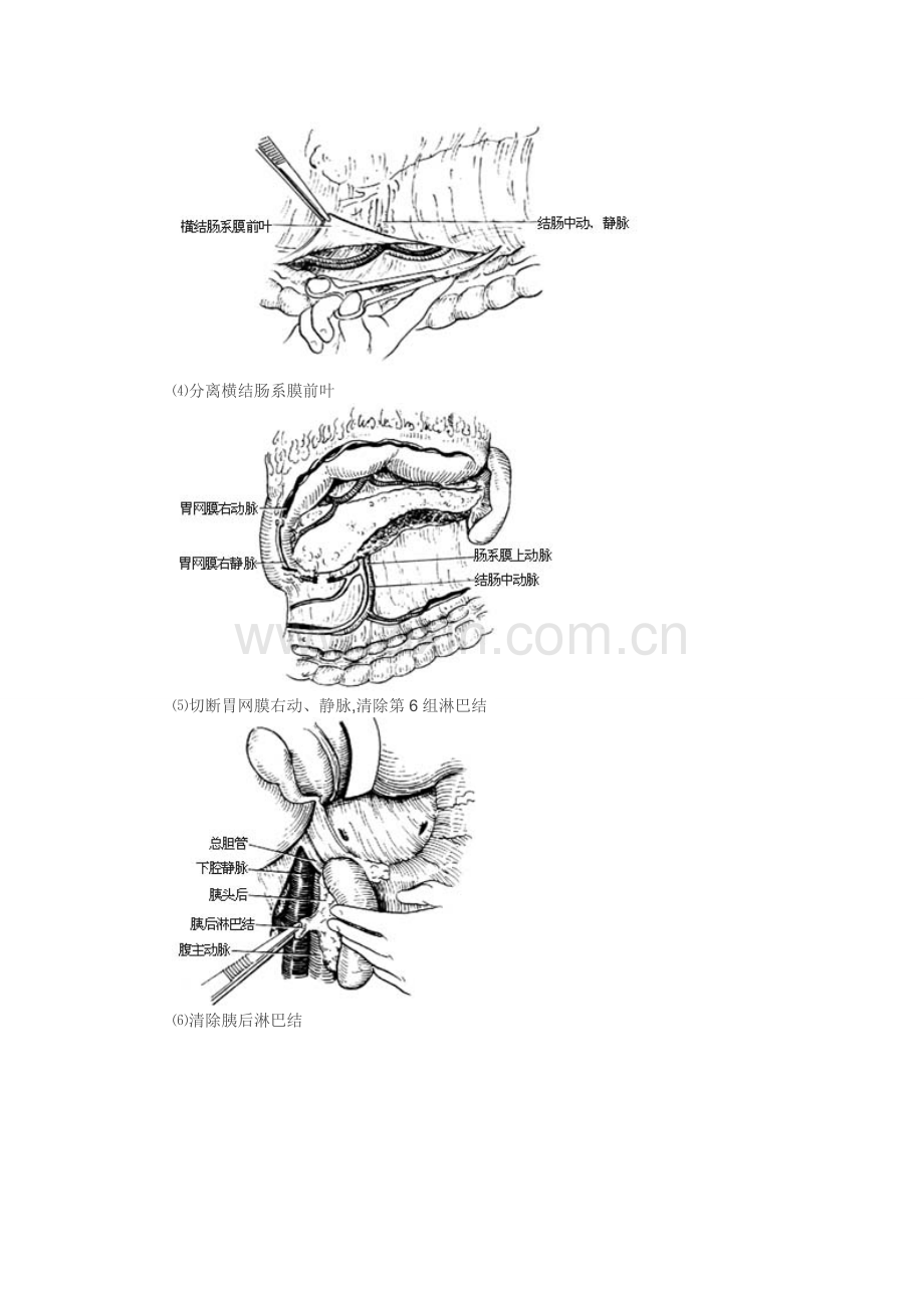 胃癌根治术全过程图解及手术常识1.doc_第3页