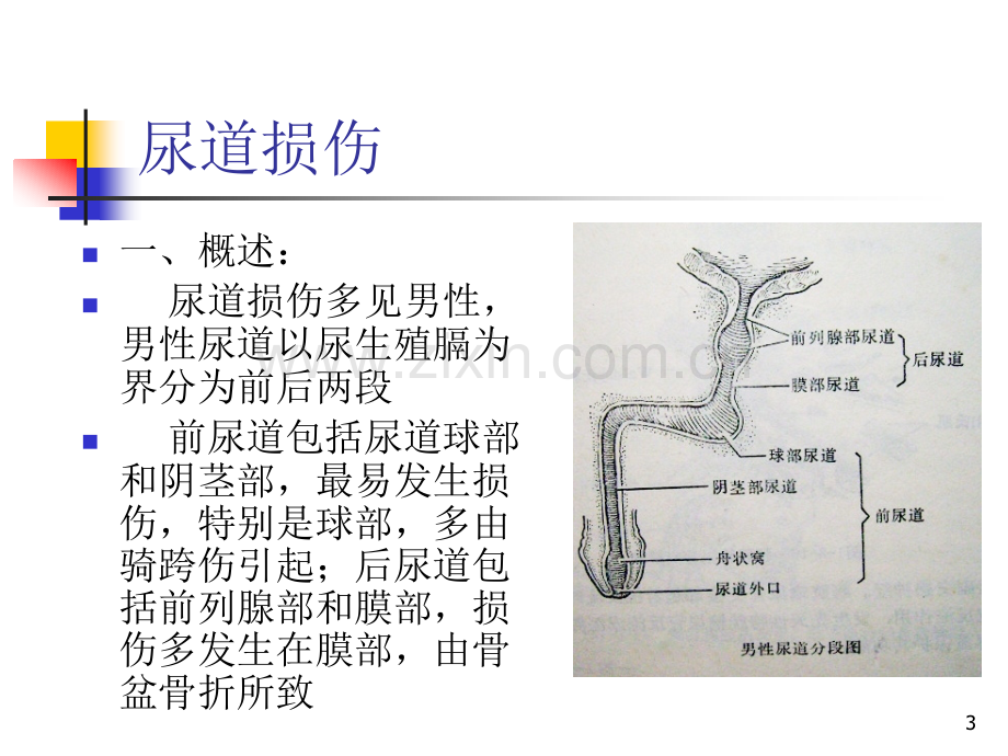 尿道损伤病人的护理.ppt_第3页