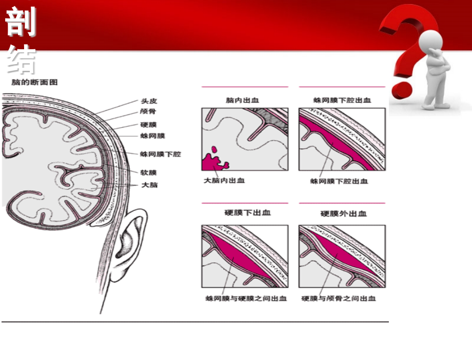 蛛网膜下腔出血护理措施.ppt_第2页