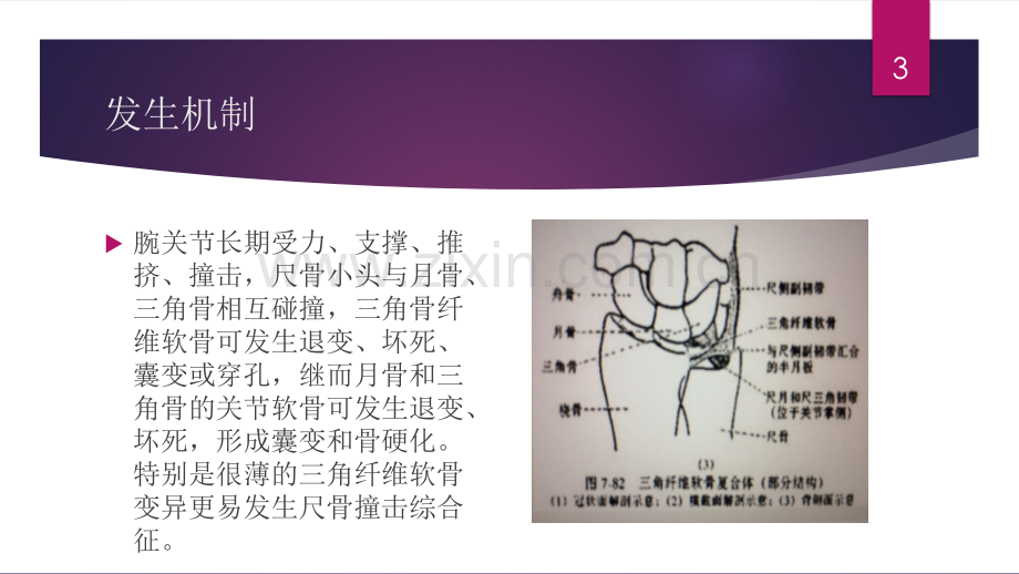 尺骨撞击综合征.ppt_第3页