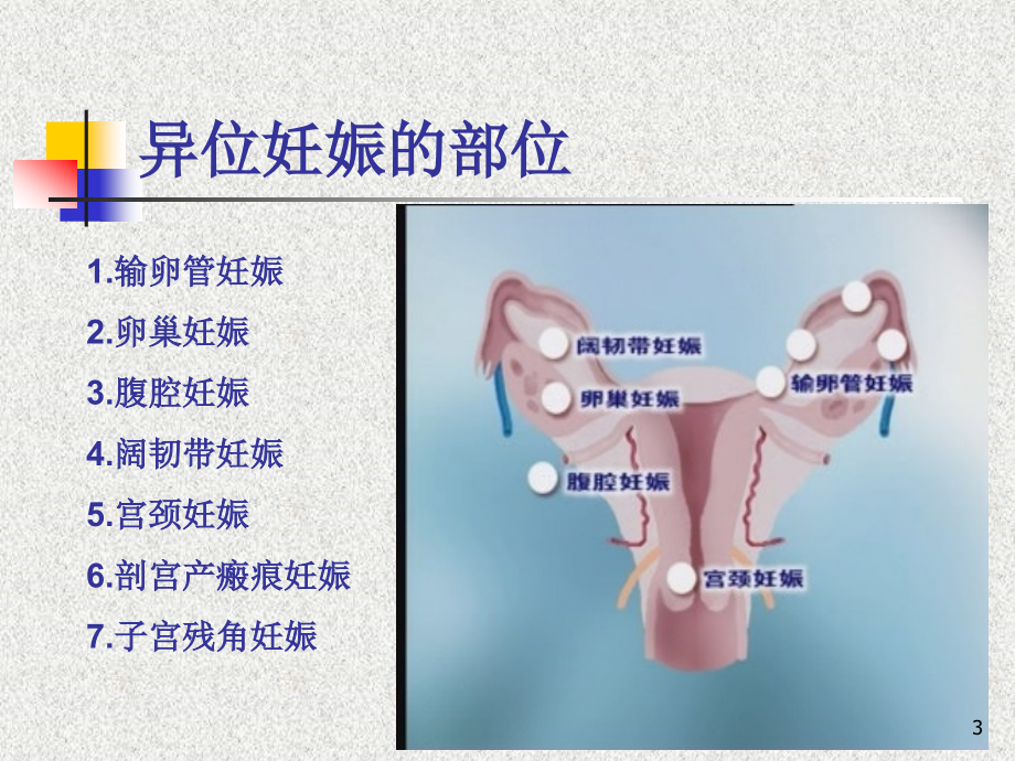 异位妊娠PPT课件.ppt_第3页