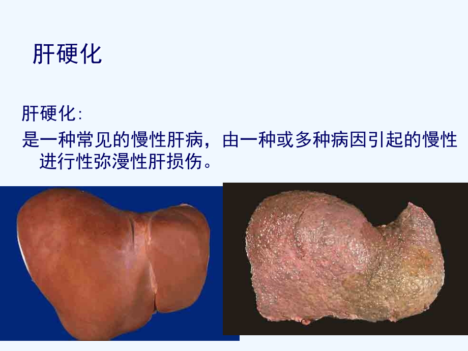 健康宣教1.肝硬化.ppt_第3页