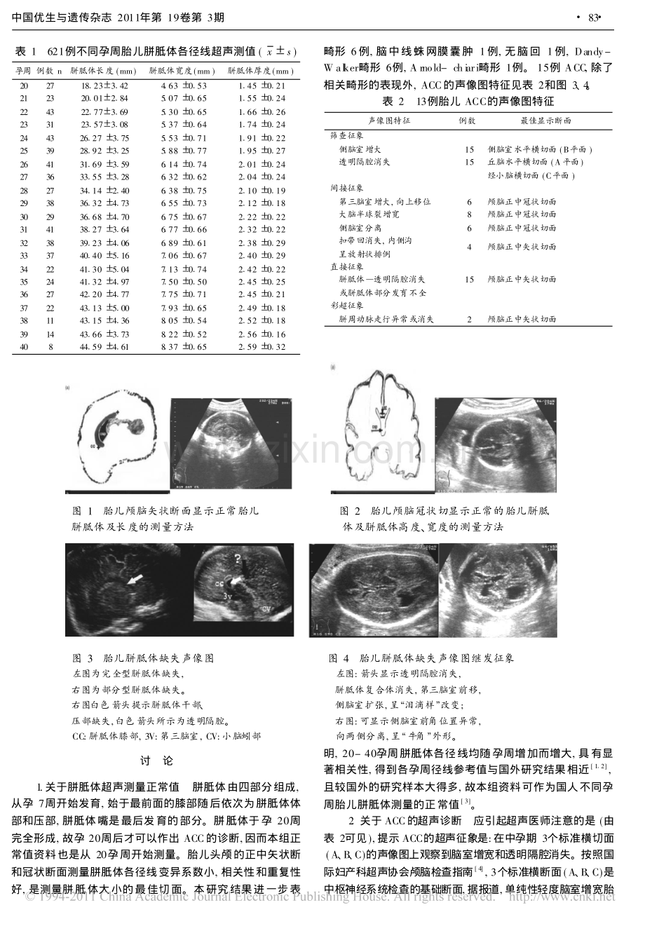 超声检测胎儿胼胝体发育及畸形.pdf_第2页