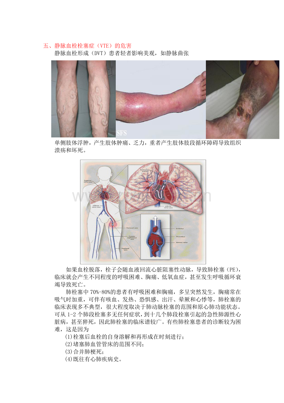 认识静脉血栓栓塞症.doc_第3页