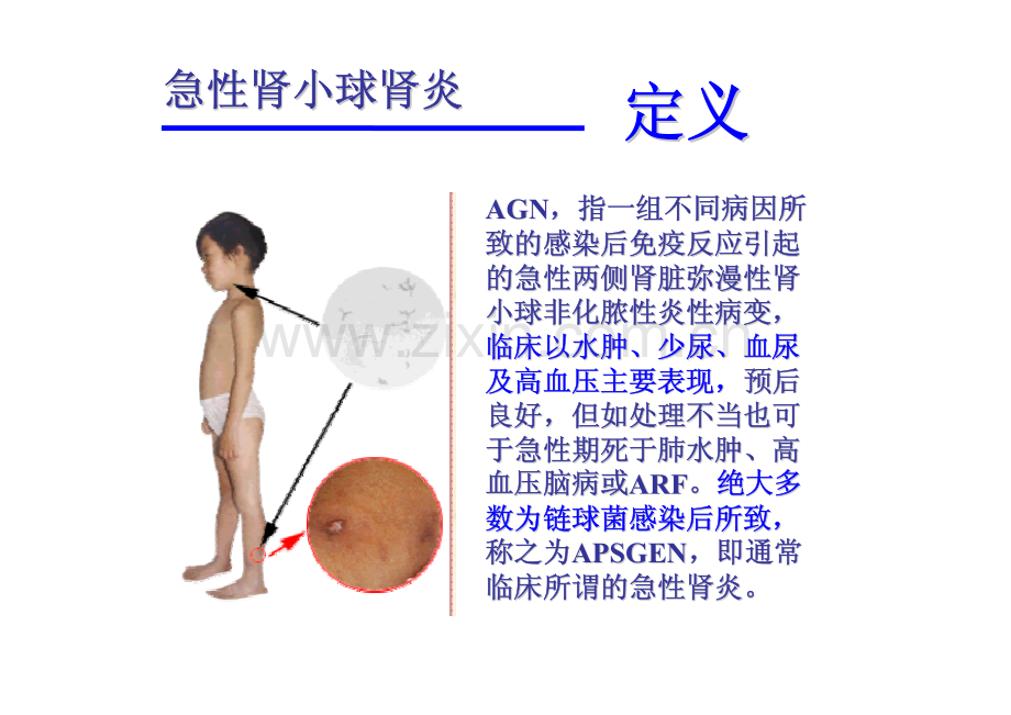 小儿急性肾小球肾炎..ppt.pdf_第2页