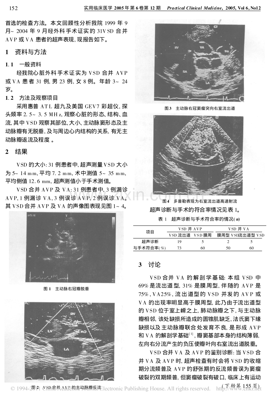 先天性心脏病室间隔缺损合并主动脉瓣脱垂或主动脉窦瘤的超声诊断.pdf_第2页