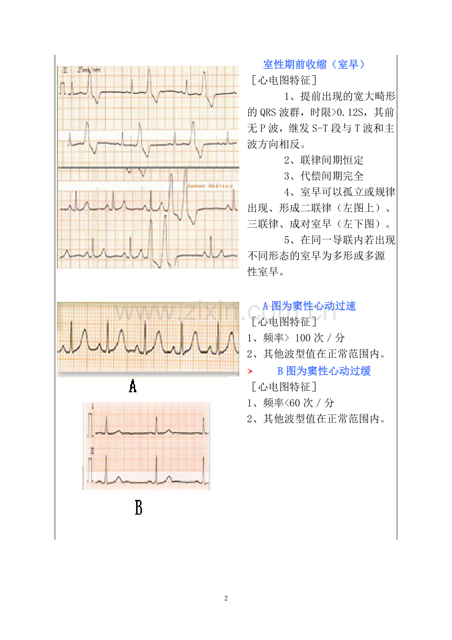 常见心电图诊断图谱.doc_第2页