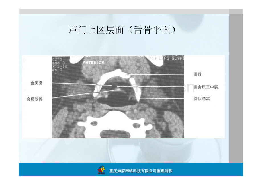 正常喉部CT解剖.pdf_第2页