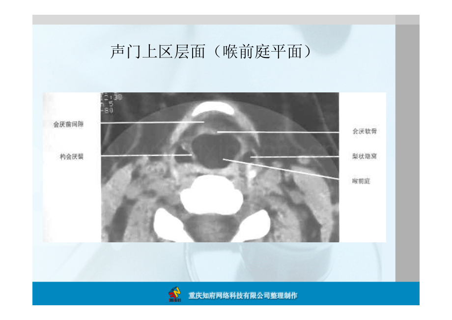 正常喉部CT解剖.pdf_第3页