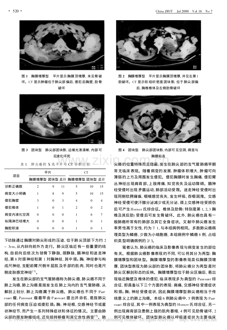 肺尖癌的临床及影像诊断.pdf_第2页