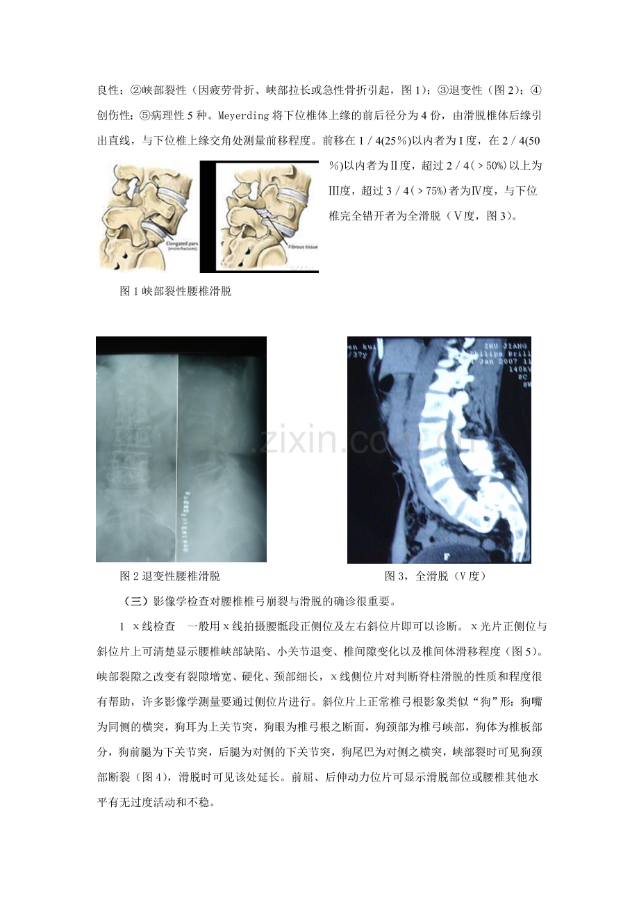 腰椎间盘突出症与腰椎滑脱鉴别.doc_第2页