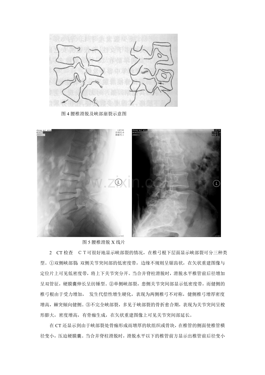 腰椎间盘突出症与腰椎滑脱鉴别.doc_第3页