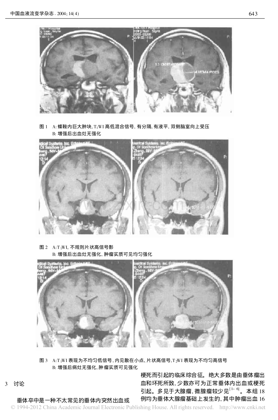 垂体瘤卒中的MRI诊断.pdf_第2页